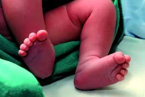 നവജാതശിശുക്കളിൽ ജനിതകവൈകല്യം കൂടുന്നു; ഏറ്റവും കൂടുതൽ തിരുവനന്തപുരത്ത്