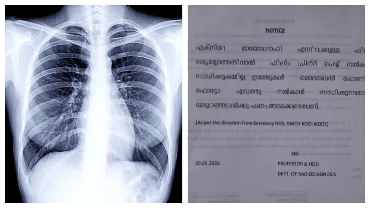 കോഴിക്കോട് മെഡിക്കൽ കോളേജിൽ എക്സ് റേ ഫിലിമില്ല, മൊബൈൽ ഫോണിൽ ഫോട്ടോയെടുക്കാൻ നിർദേശം, രോ​ഗികൾ വലയുന്നു