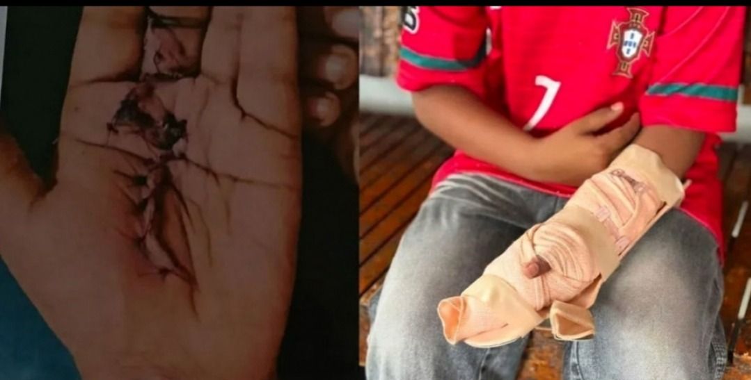 കൊയിലാണ്ടി താലൂക്ക് ആശുപത്രിയിൽ ചികിത്സാപ്പിഴവെന്ന് പരാതി; ഒമ്പതാം ക്ലാസുകാരന്റെ വിരലിന്റെ ചലനശേഷി നഷ്ടമായി